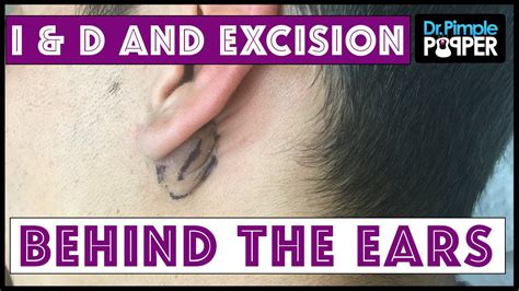 Benign Ear Cyst Or Tumor Pictures