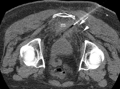 Various Approaches For Ct Guided Percutaneous Biopsy Of Deep Pelvic
