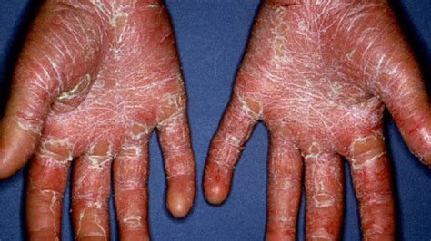 Maybe you would like to learn more about one of these? Misdiagnosis of Psoriasis: Know the Facts