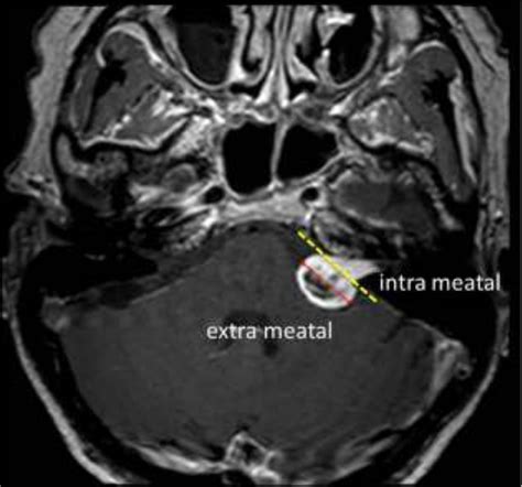 MR image of left sided vestibular schwannoma. Yellow ...