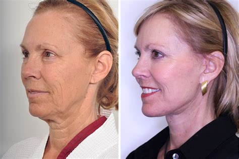 Rhytidectomy Facelift Neck Lift For Women In New York City David