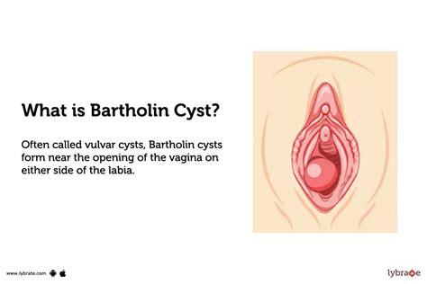 Bartholin Cyst What Is It Causes And More Osmosis OFF