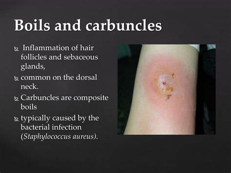 Ppt Infections And Allergies Of Skin Powerpoint Presentation Free