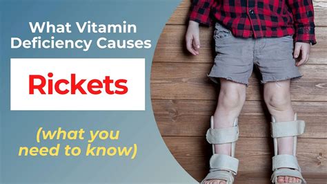 What Vitamin Deficiency Causes Rickets — Eating Enlightenment
