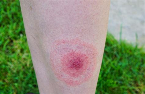 lyme disease tick bite rash
