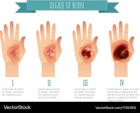 What Do Third Degree Burns Look Like