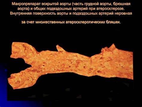 Тромбоз.Эмболия.атеросклероз.С-м Лериша - online presentation Картинка - Тромбоз.Эмболия.атеросклероз.С-м Лериша - online presentation