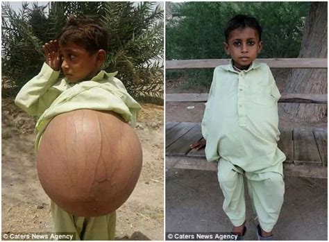 Meet Year Old Boy Who Is Pregnant Due To Rare Disease Photos
