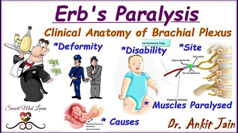 Erb S Palsy And Brachial Plexus Injuries In Babies Plexus Products