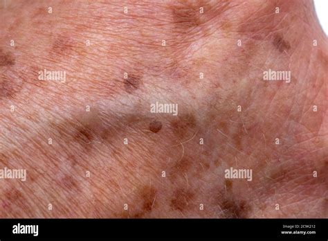 Age Or Liver Spots On An Elderly Womans Hand Stock Photo Alamy