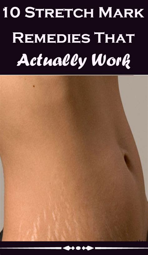 10 Stretch Mark Remedies That Actually Work