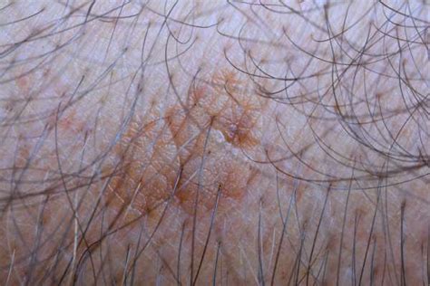 Seborrheic Keratosis Removal From Spire Glasgow Book Now