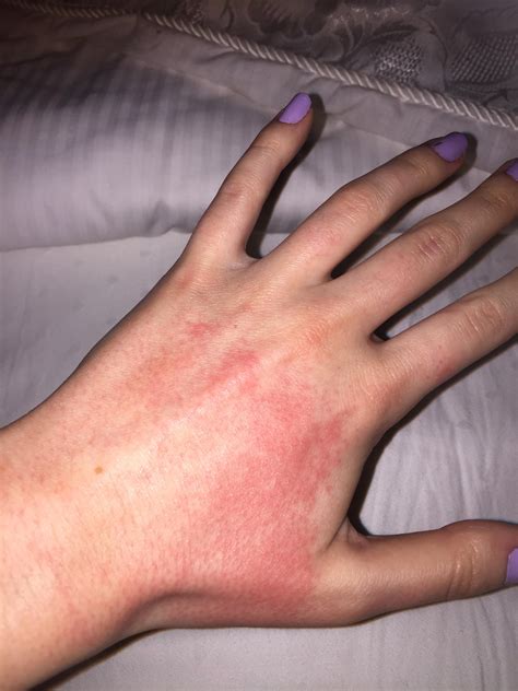 Why Do I Have A Red Rash On My Hand