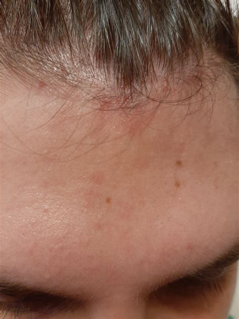Very Itchy Scalp Area Especially 2 Days After Washing If I Scratch It