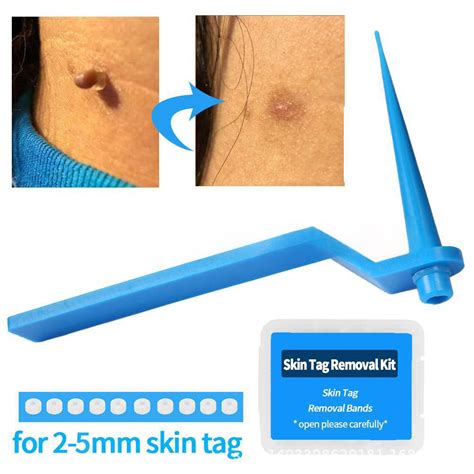 adult mole kulugo remover kit with cleansing pads skin tag remover band warts removal rubber