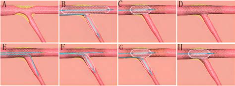 Simple Stenting Strategy With Or Without Branch Ostial Optimization Technique For Treatment Of