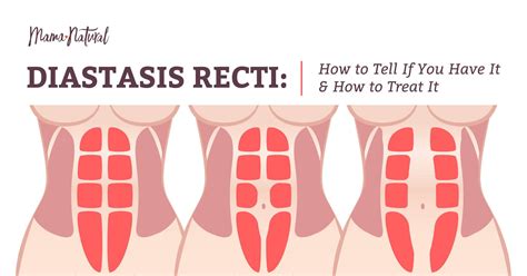 How To Tell If You Have Diastasis Recti Abdominal Gap Diastasis Vrogue
