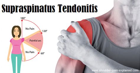 Supraspinatus Tendonitis Causes Symptoms Treatment Supraspinatus