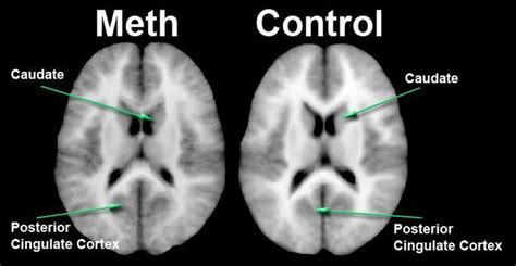 Researchers Id Brain Abnormalities In Children Exposed To