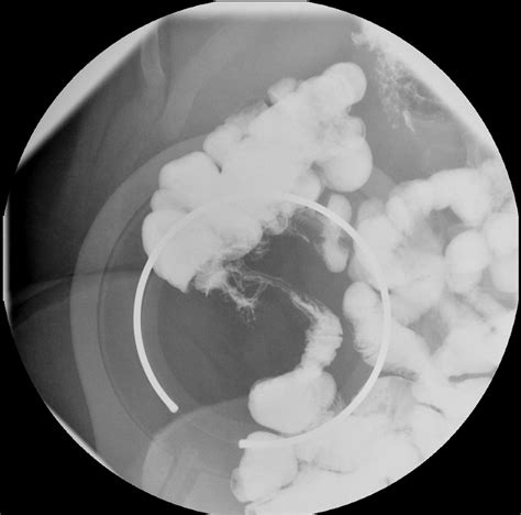The String Sign A Rare Radiologic Manifestation Of Crohn Disease