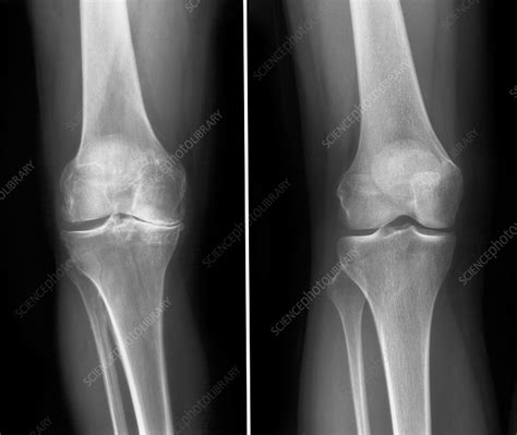 X Rays Of Normal And Degenerative Knees Stock Image C0075868