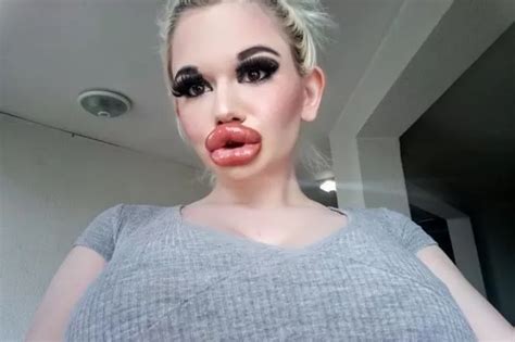 Woman With Biggest Lips In World Shows Off Huge New Pout After Th