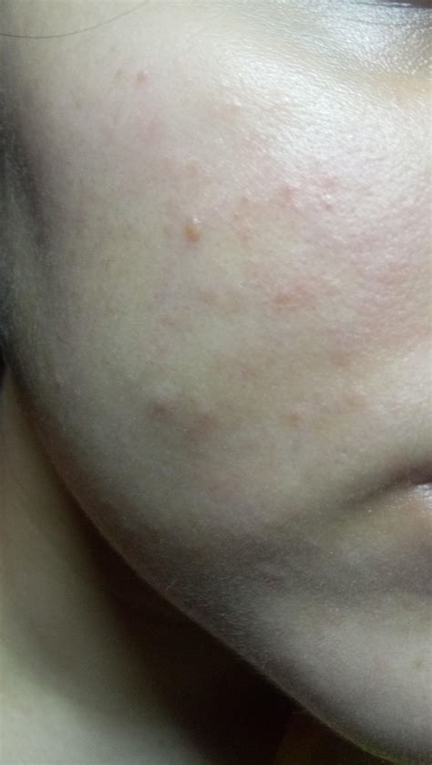 Skin Concern Help Is This An Allergic Reaction Rskincareaddiction