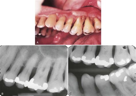 7 Periodontal Diseases Pocket Dentistry