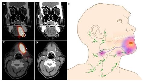 Early Stage Cancer Lymph Nodes In Neck Weloveatila