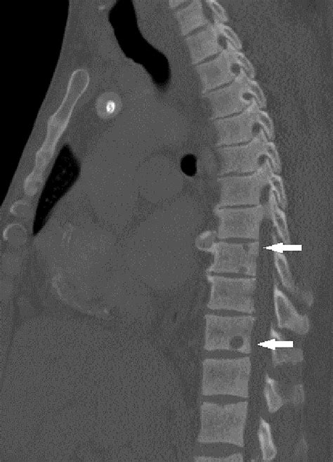 Cureus Brown Tumor With Spine Involvement At Multiple Levels In A