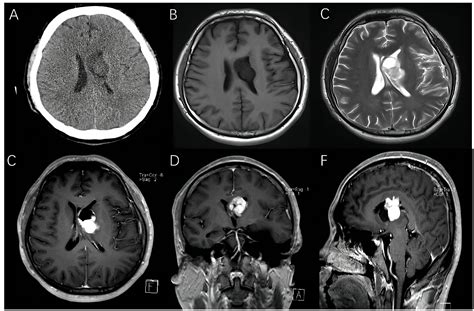 Frontiers Hemangioblastoma In The Lateral Ventricle An Extremely