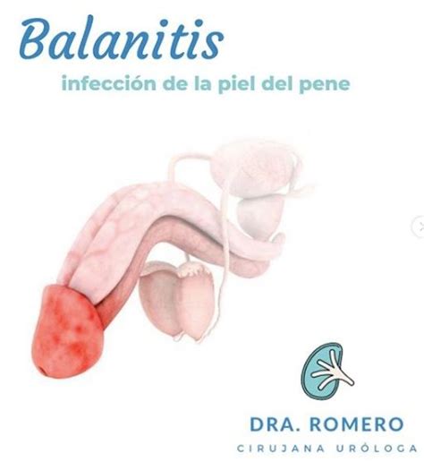 balanitis infección de la piel del pene