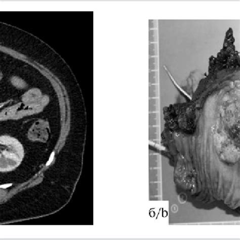 Intraductal Papillary Mucinous Tumor Associated With Ductal