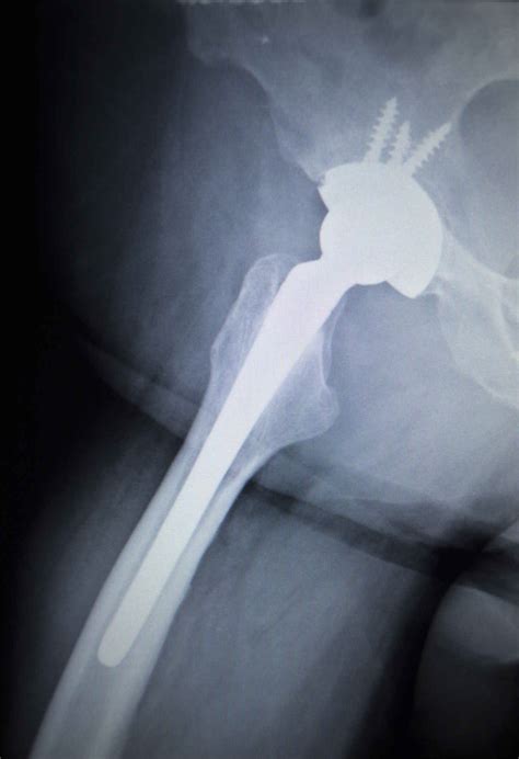 Growing Litigation Alleges Problems With The Stryker Lfit Hip Implant