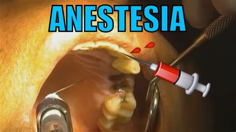 Anestesia Dental Hd Youtube