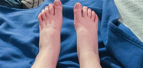 Are Swollen Feet A Sign Of Diabetes —