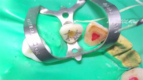 Maxillary Incisor Access Cavity Preparation Endodontic Youtube