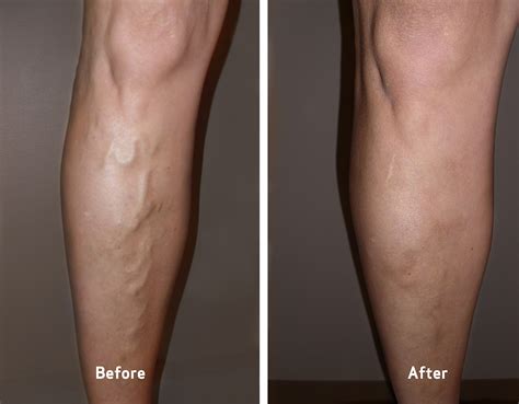 Varicose And Spider Veins Before And After Photos Vein Clinics Of America