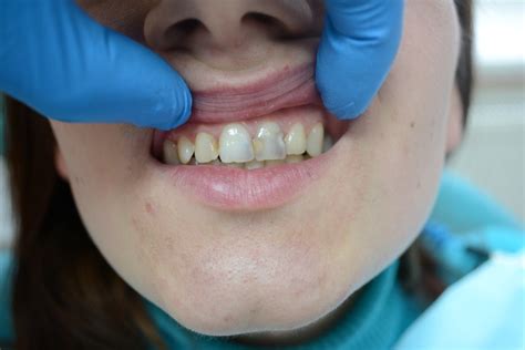 Кариес передних зубов и его лечение в Сумах