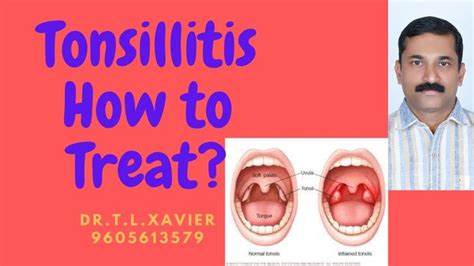 Tonsillitis How To Treat How To Prevent Tonsillitis Health Talk