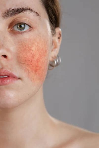 Cosmetología Y Rosácea Retrato De La Mitad Del Rostro De Una Joven Con