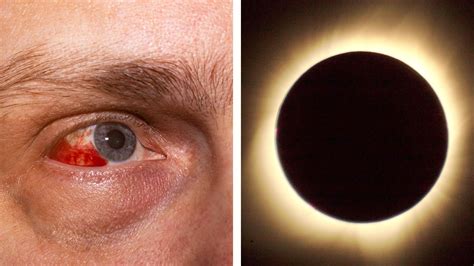 Retinopatía solar qué es esta afección que puede causar ceguera por ver un eclipse sin