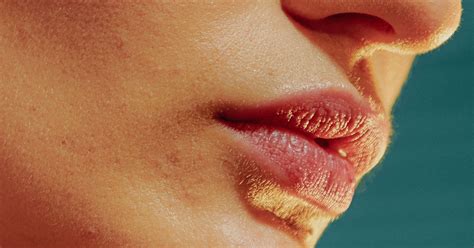 What To Do For Sunburned Lips How To Prevent And Treat