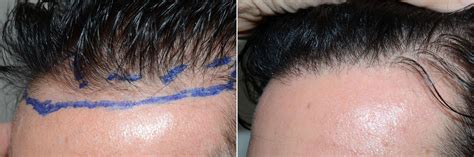 Different Types Of Hair Transplants Best Type Of Hair Transplant