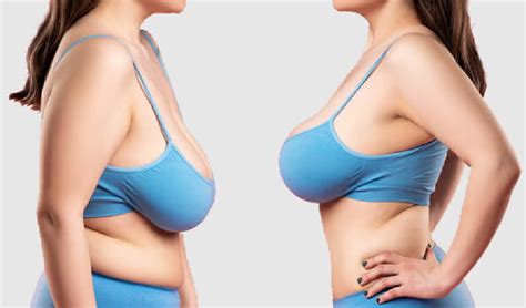 differences between mammoplasty and mastopexy plastic surgery mediniz health post