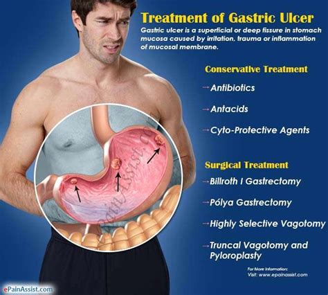 Gastric Ulcer Symptoms And Treatment UlcerTalk Com