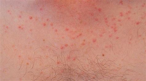 Bumps On Chest Small Red Rashes Acne Vulgaris And Bumps Not Acne