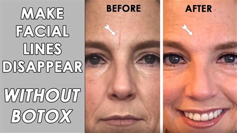 Fix Wrinkles Without Botox Youtube