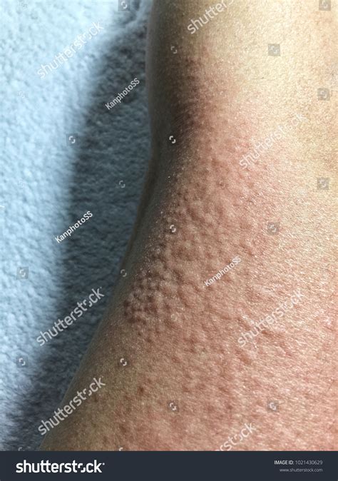 Cold Urticaria Allergic On Blur Leg Stock Photo 1021430629 Shutterstock