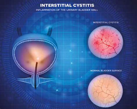 Interstitial Cystitis Algorithm To Simplify Diagnosis Of Chronic Urinary Symptoms